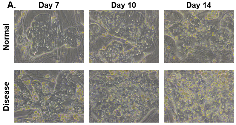 Figure 1. Morphology of Normal and Diseased PHHs. (A) Representative images of Normal (top row) and Diseased (bottom row) PHHs in the hTCS on days 7, 10, and 14. (B) Representative images of Nile Red Staining of Normal (top row) and Diseased (bottom row) PHH on day 14 in the hTCS. Magnification: 10X.