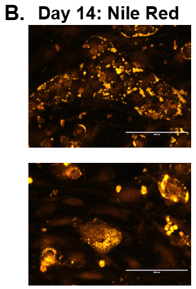 Figure 1. Morphology of Normal and Diseased PHHs. (A) Representative images of Normal (top row) and Diseased (bottom row) PHHs in the hTCS on days 7, 10, and 14. (B) Representative images of Nile Red Staining of Normal (top row) and Diseased (bottom row) PHH on day 14 in the hTCS. Magnification: 10X. Figure 1. Morphology of Normal and Diseased PHHs. (A) Representative images of Normal (top row) and Diseased (bottom row) PHHs in the hTCS on days 7, 10, and 14. (B) Representative images of Nile Red Staining of Normal (top row) and Diseased (bottom row) PHH on day 14 in the hTCS. Magnification: 10X.