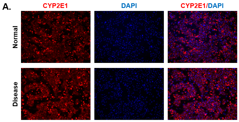 CYP2E1 Expression in Normal and Diseased PHHs. (A) Staining for CYP2E1 (red) expression and DAPI (Blue) with the merged image shown (blue and red) on day 15.