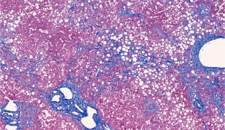 Modeling Compound-Induced Fibrogenesis 